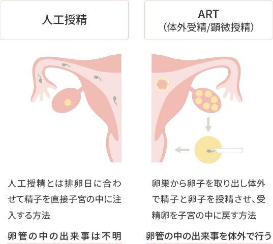 イラスト：人工授精と体外受精の違い