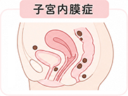 イメージイラスト：子宮内膜症