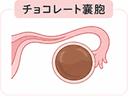 イメージイラスト：チョコレート嚢胞