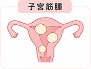 イメージイラスト：子宮筋腫