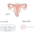 男性因子以外の場合のICSIについて
